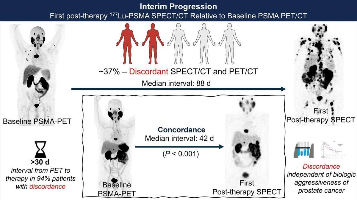Evaluating Interim Progression: First Posttherapy 177Lu-PSMA SPECT/CT Relative to Baseline PSMA PET/CT.的论文原文Figure 1