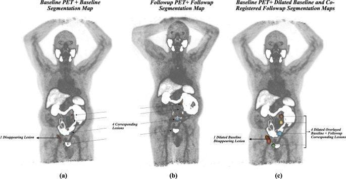 Automated lesion tracking and treatment response classification on [68Ga]Ga-PSMA-11 PET/CT across PPP,RECIP 1.0 and TLW frameworks.的原文研究流程或关键结果图