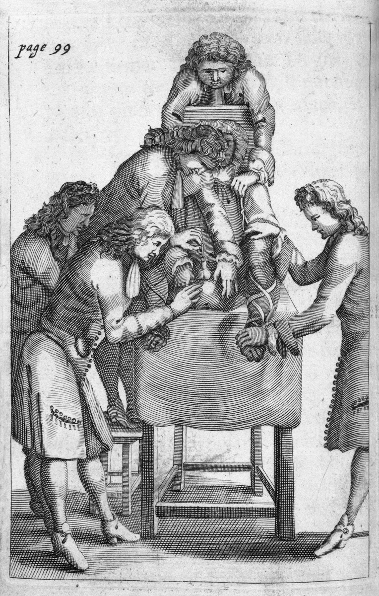 图7　François Tolet著作中的膀胱切石术图版，约1683年，患者体位、助手固定与会阴入路同时可见。