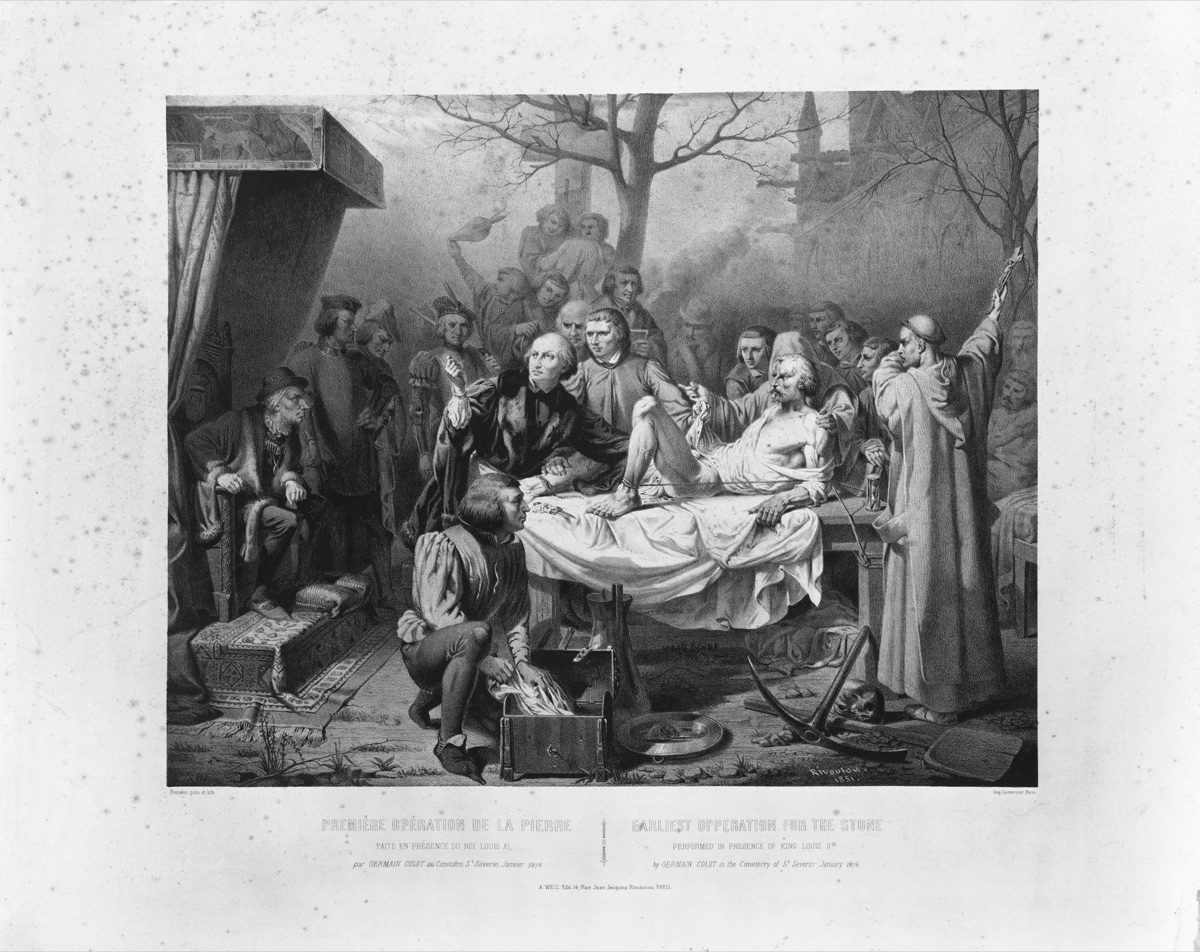图10　Antoine Rivoulon于1851年绘制的Germain Colot膀胱结石手术石版画；术者、助手、患者和围观者挤在同一现场。
