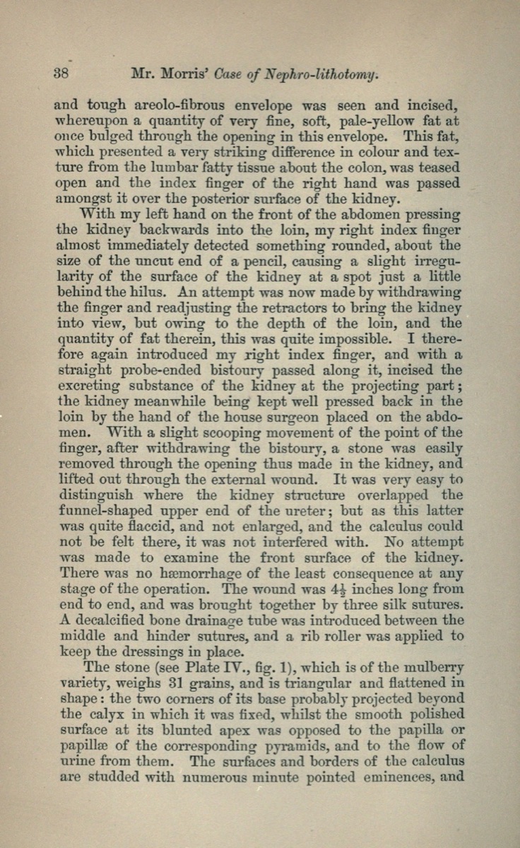 图21　Henry Morris（亨利·莫里斯）于1881年刊出的nephro-lithotomy病例报告页。英文记录Morris以左手从腹前把肾压向腰部，再用右手食指触到凸起，并沿指尖送入probe-ended bistoury（探针尖手术刀）切开肾实质。取出的mulberry calculus重31 grains，切口随后以三根丝线缝合并放置引流管。