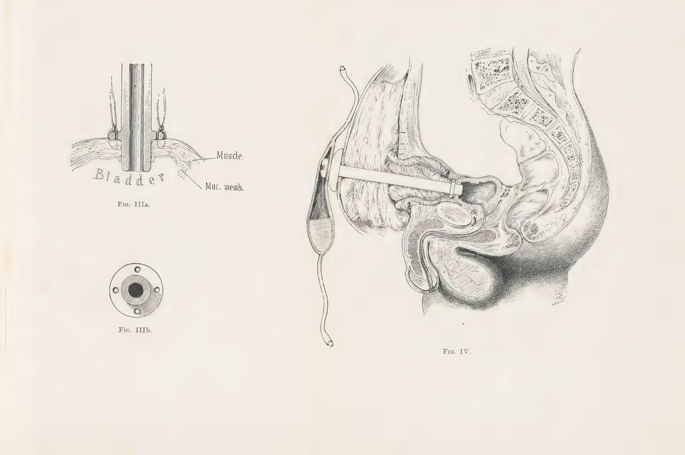 图22 Joseph C. Bloodgood于1896年刊出的耻骨上膀胱引流装置图。Fig. IIIa与Fig. IIIb画出膀胱壁处的固定结构，Fig. IV画出耻骨上导管、体外连接管和收集袋的位置关系。
